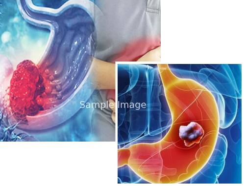 Stomach Cancer Types