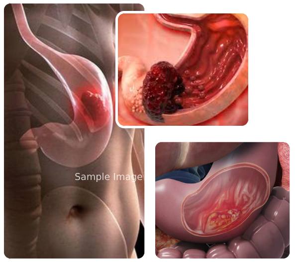 Stomach Cancer Types