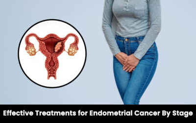 Effective Treatments for Endometrial Cancer by Stage